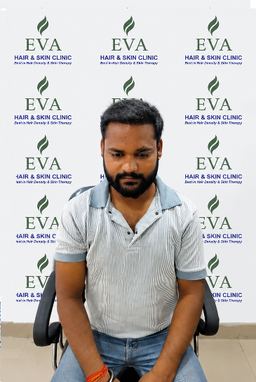 After hair transplant result 3